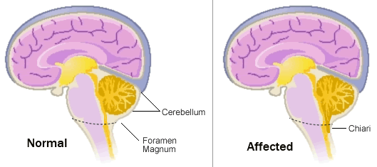 Chiari malformation diagram