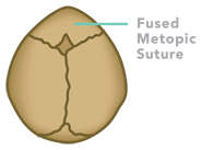 Metopic Craniosynostosis 