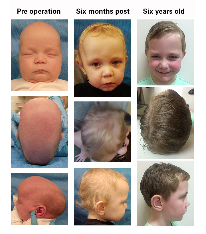 Sagittal craniosynostosis patient