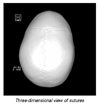 Three-dimensional view of sutures